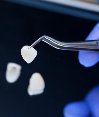 Dental veneer being held with tweezers
