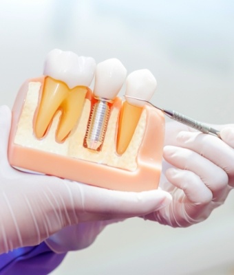 Dentist pointing to a model of the jaw with a dental implant