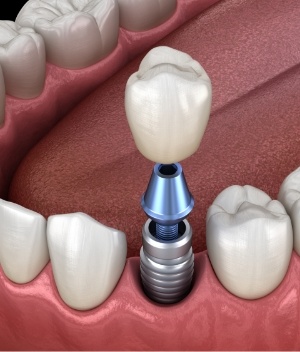 Animated dental implant with dental crown