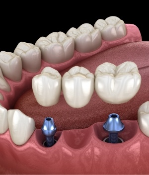 Two animated dental implants with a dental bridge