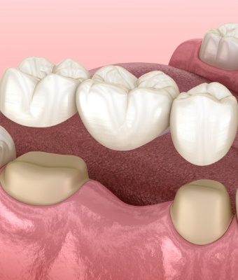 Animated dental bridge replacing a missing tooth