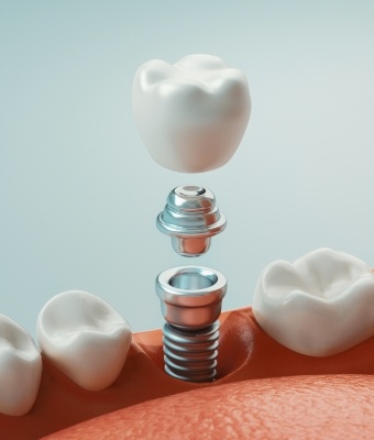 Animated dental implant with dental crown replacing a missing tooth