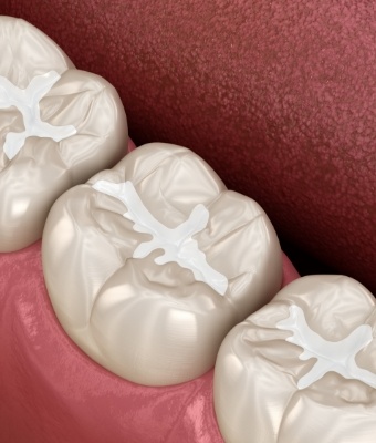 Animated row of teeth with dental sealants