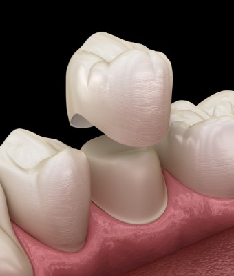 Animated dental crown being placed over a tooth