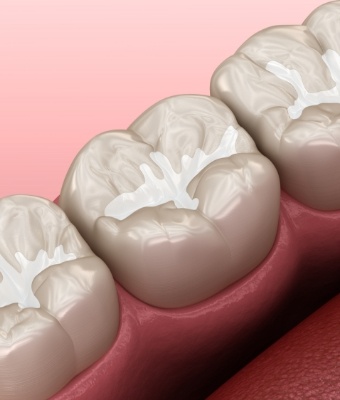 Animated row of teeth with tooth colored fillings